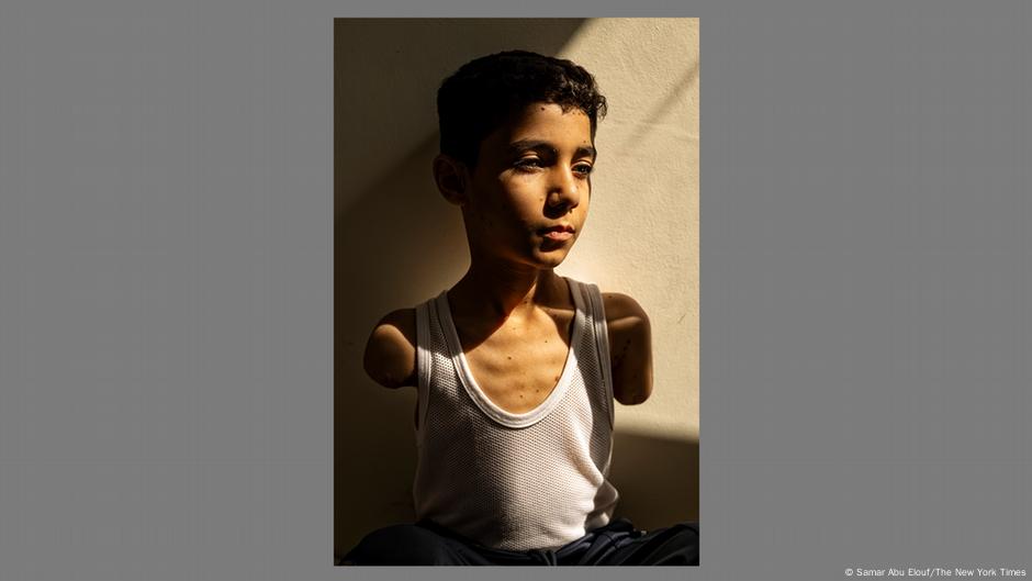 طفل فلسطيني مبتور الذراعين يحصد جائزة "صورة العام" 2 طفل فلسطيني مبتور الذراعين يحصد جائزة “صورة العام”