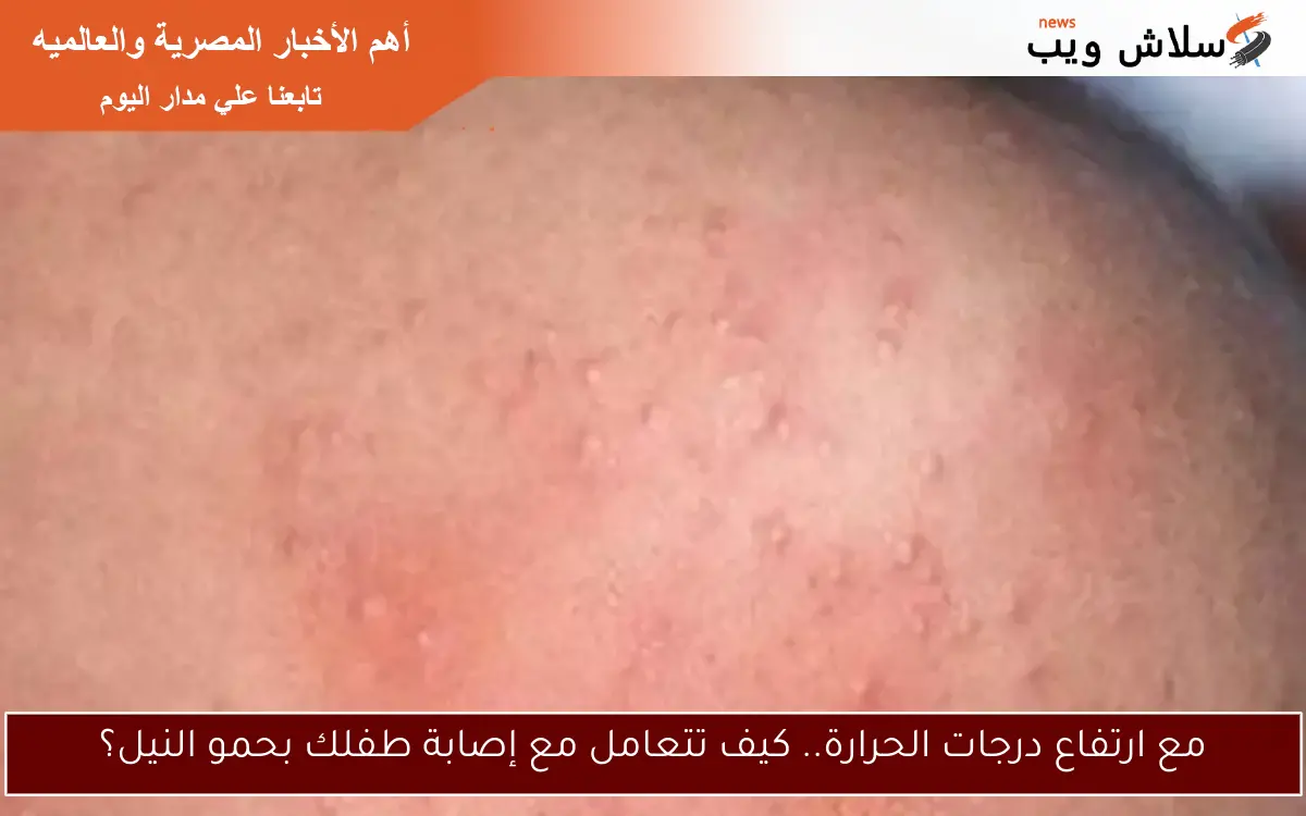مع ارتفاع درجات الحرارة.. كيف تتعامل مع إصابة طفلك بحمو النيل؟