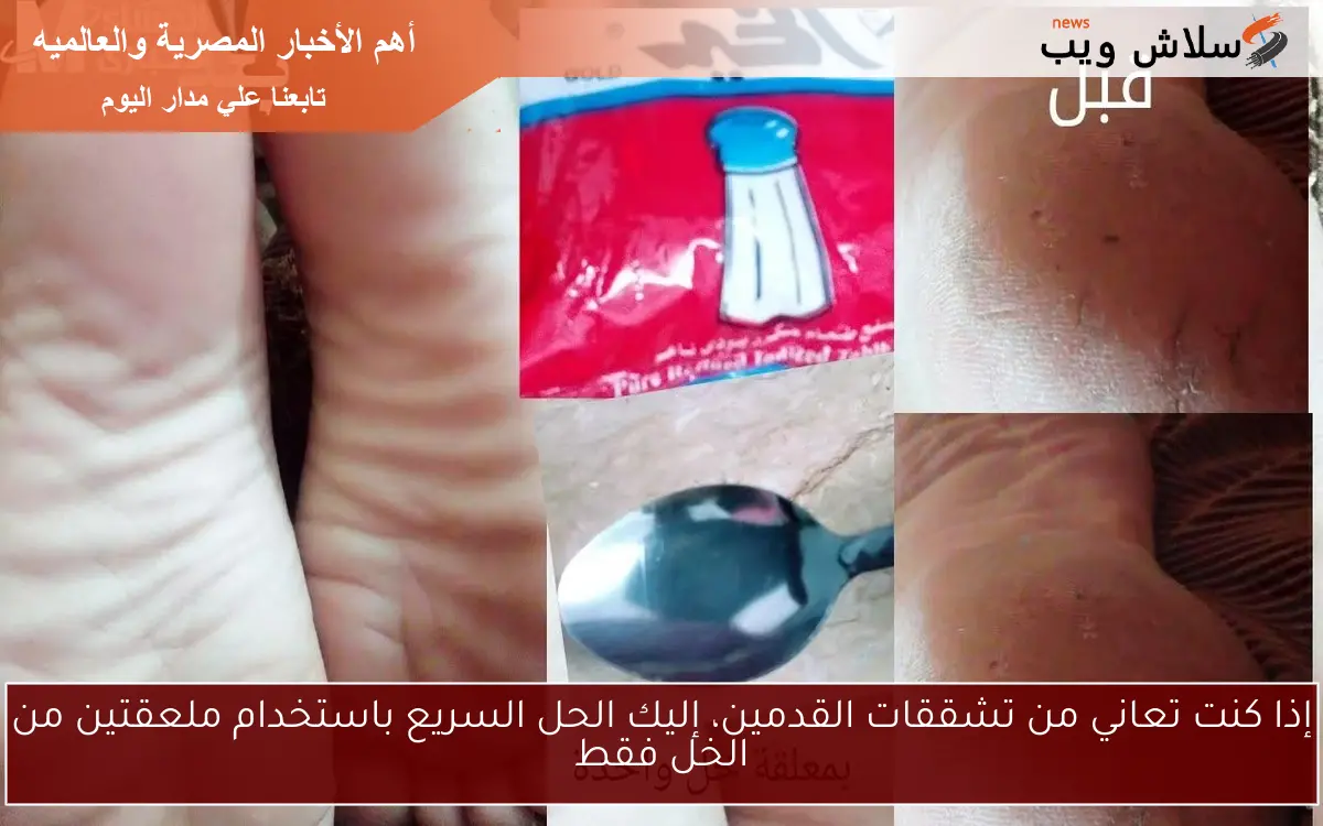 إذا كنت تعاني من تشققات القدمين، إليك الحل السريع باستخدام ملعقتين من الخل فقط 2 إذا كنت تعاني من تشققات القدمين، إليك الحل السريع باستخدام ملعقتين من الخل فقط