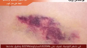 في شهر التوعية، تعرف على الساركوما وطرق علاجها