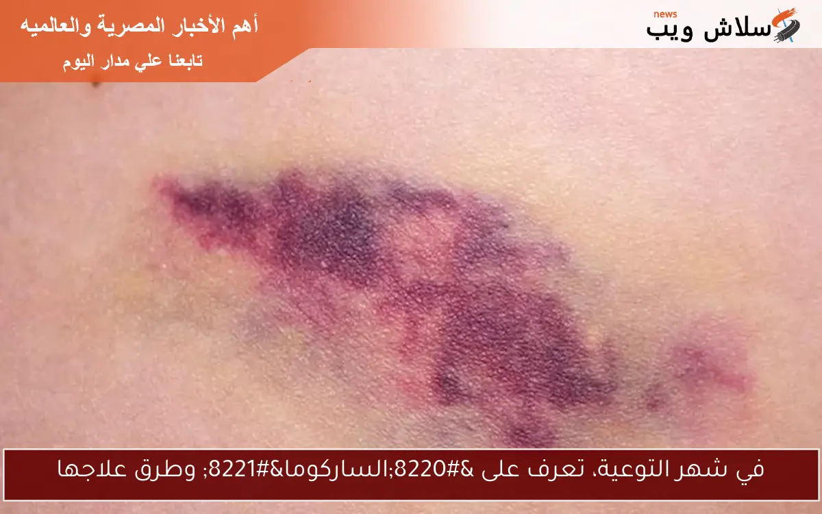 في شهر التوعية، تعرف على "الساركوما" وطرق علاجها 2 في شهر التوعية، تعرف على “الساركوما” وطرق علاجها